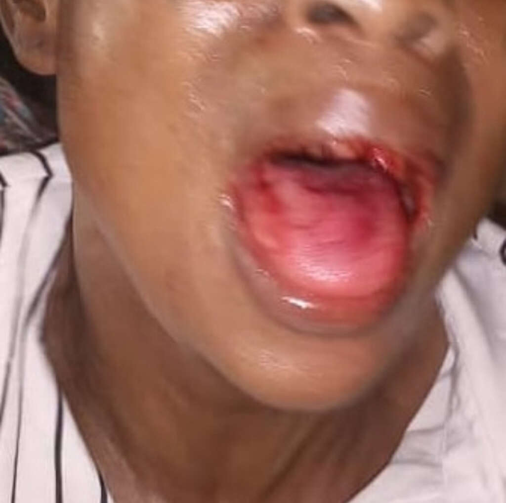 Domestic violence- Husband knocks out his wife's teeth