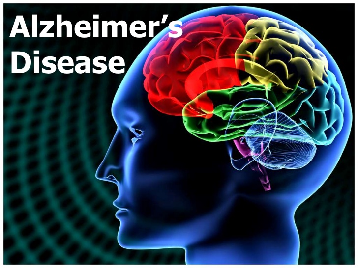 US release Alzheimer's drug