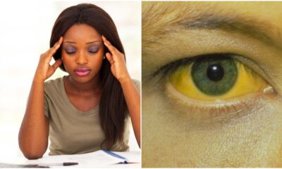 Causes, symptoms and ways to prevent yellow fever
