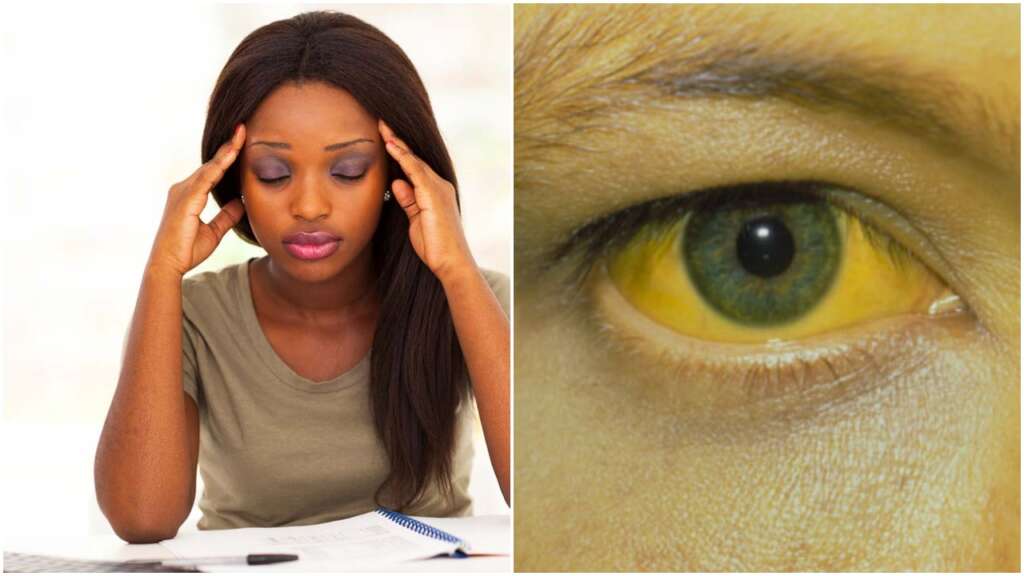 Causes, symptoms and ways to prevent yellow fever