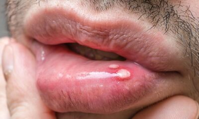 Everything To Know About Oral Herpes And How It Can Be Cured