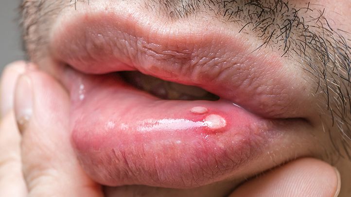 Everything To Know About Oral Herpes And How It Can Be Cured