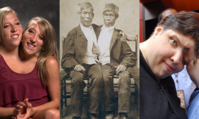 12 Most Fascinating Siamese Twins