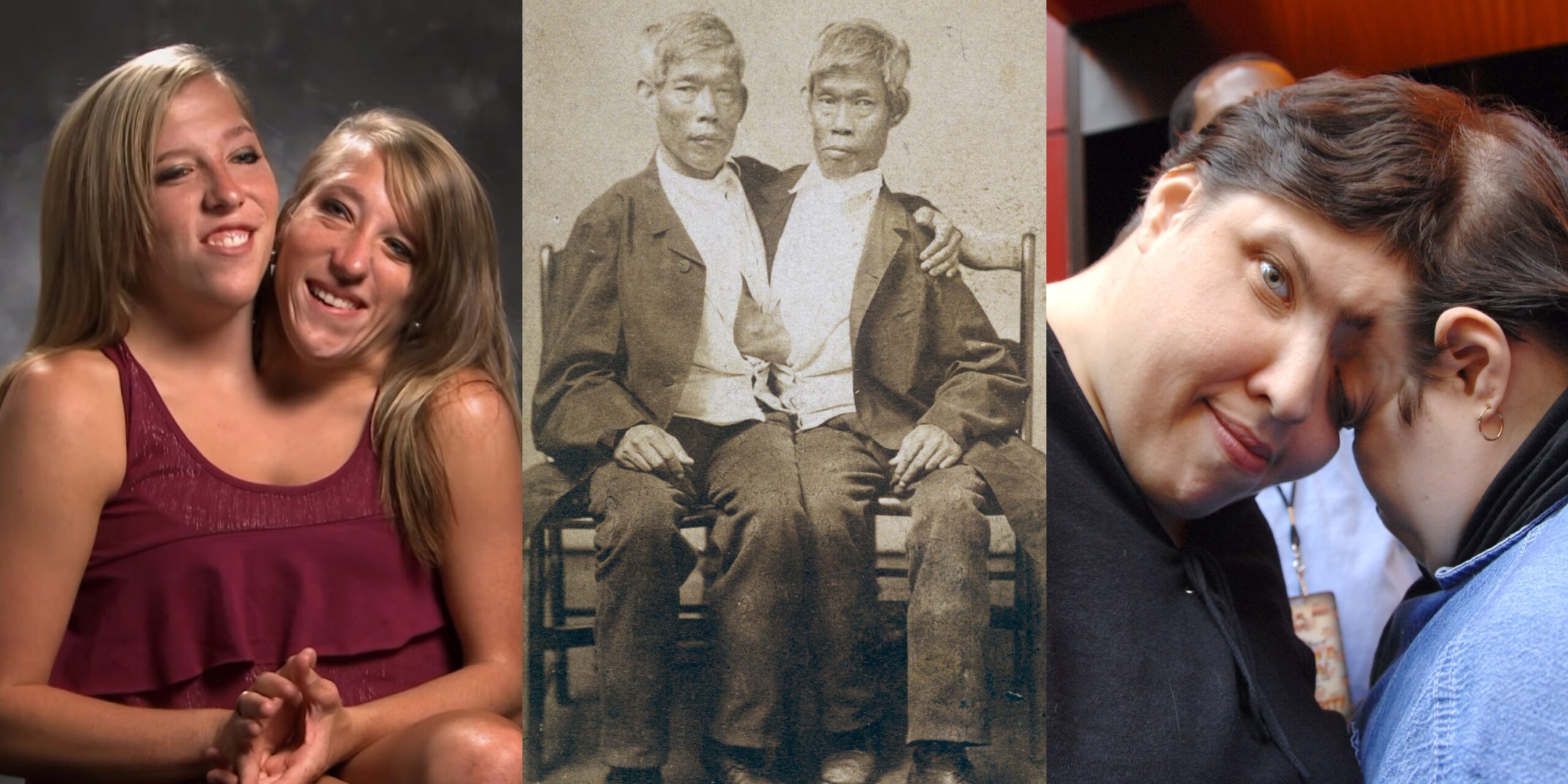 12 Most Fascinating Siamese Twins